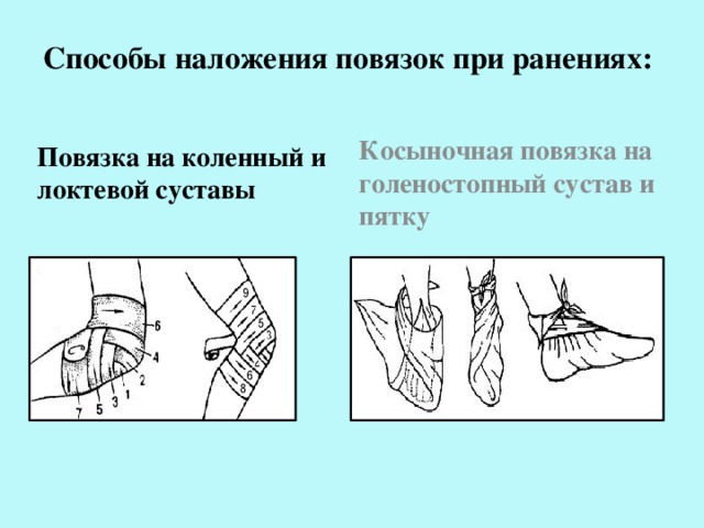 Способы наложения повязок при ранениях: Косыночная повязка на голеностопный сустав и пятку Повязка на коленный и локтевой суставы 