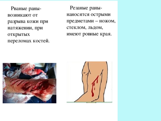  Резаные раны-наносятся острыми предметами – ножом, стеклом, льдом, имеют ровные края.  Рваные раны-возникают от разрыва кожи при натяжении, при открытых переломах костей. 