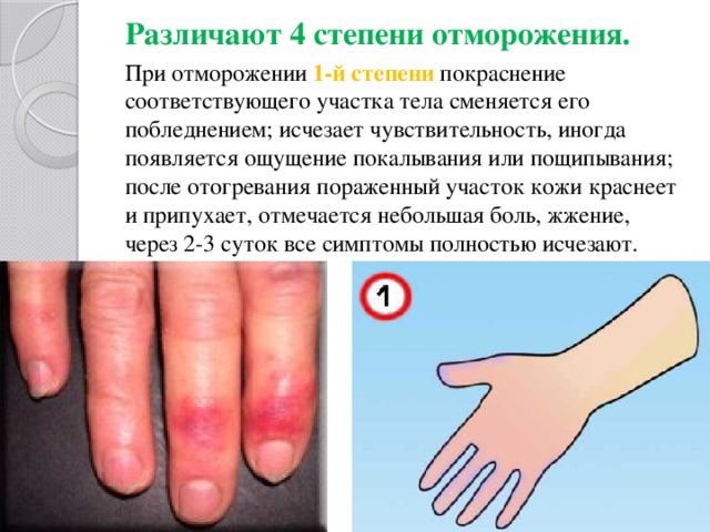Различают 4 степени отморожения. При отморожении  1-й степени  покраснение соответствующего участка тела сменяется его побледнением; исчезает чувствительность, иногда появляется ощущение покалывания или пощипывания; после отогревания пораженный участок кожи краснеет и припухает, отмечается небольшая боль, жжение, через 2-3 суток все симптомы полностью исчезают. 