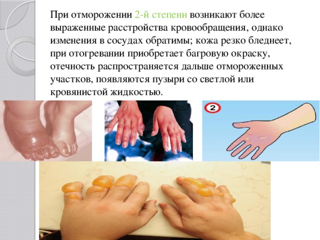 При отморожении 2-й степени возникают более выраженные расстройства кровообращения, однако изменения в сосудах обратимы; кожа резко бледнеет, при отогревании приобретает багровую окраску, отечность распространяется дальше отмороженных участков, появляются пузыри со светлой или кровянистой жидкостью. 