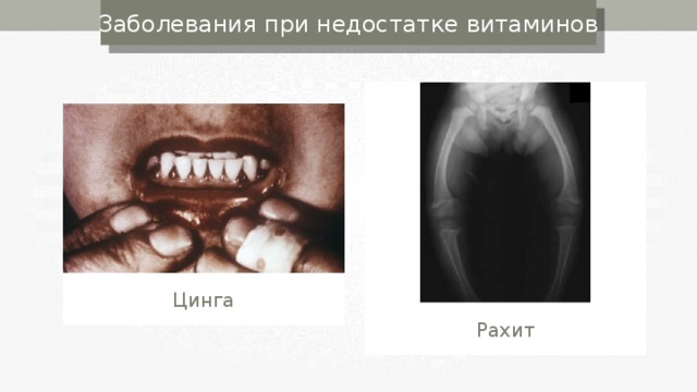 Заболевания при недостатке витаминов Цинга Рахит 