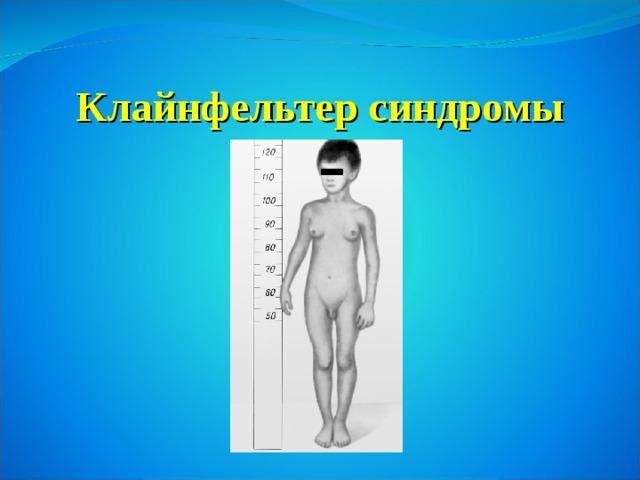 Клайнфельтер синдромы 