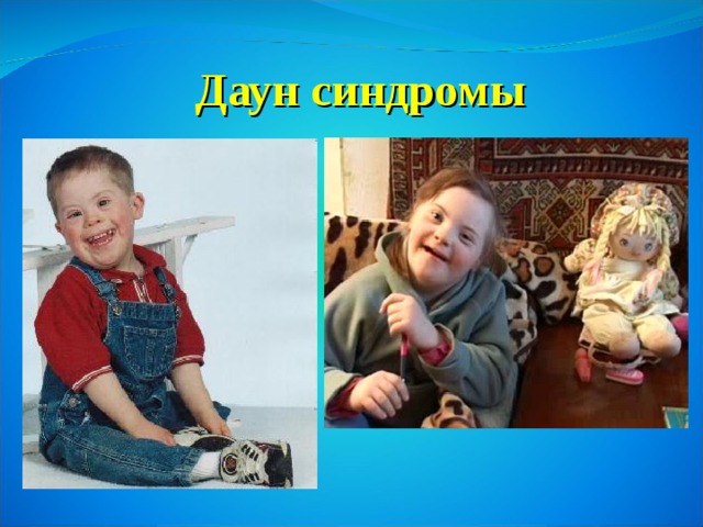 Даун синдромы 
