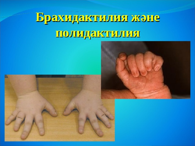 Брахидактилия және  полидактилия 