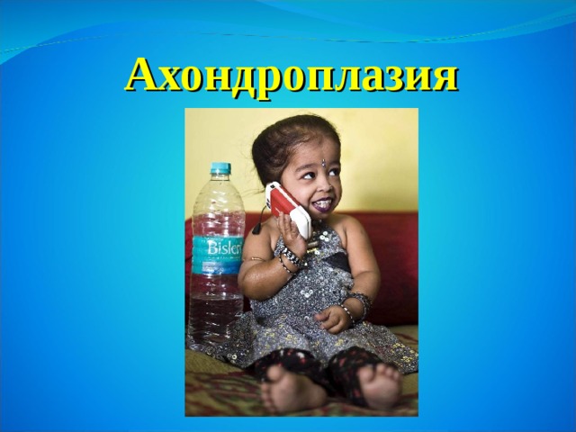 Ахондроплазия 