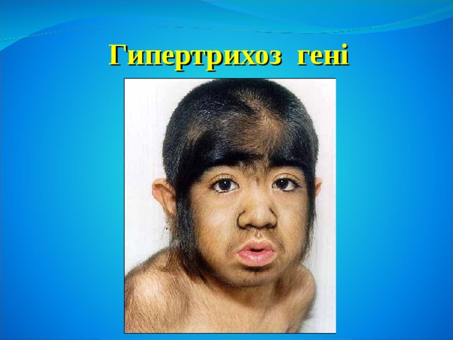 Гипертрихоз гені 