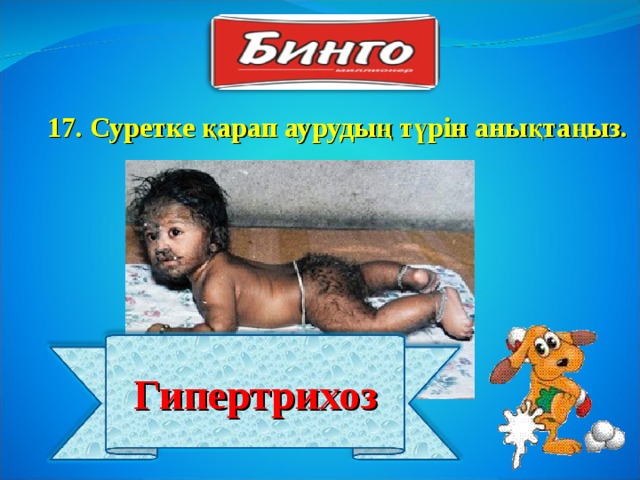 17 . Суретке қарап аурудың түрін анықтаңыз. Гипертрихоз 