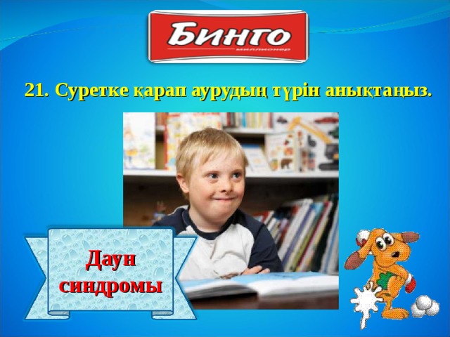 21 . Суретке қарап аурудың түрін анықтаңыз. Даун синдромы 