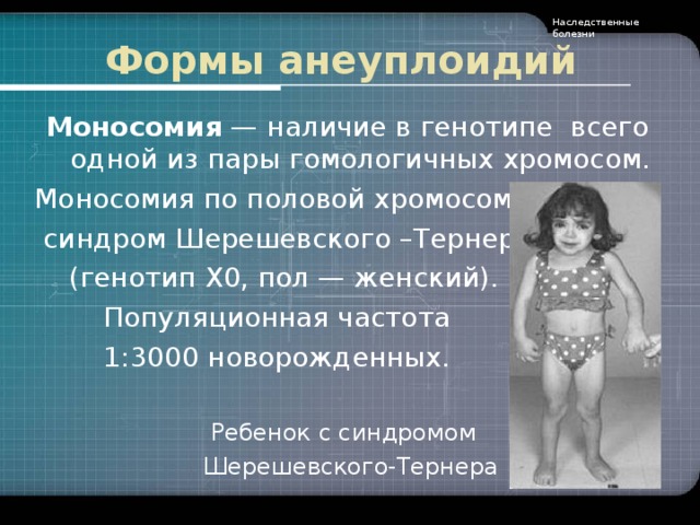 Наследственные болезни Формы анеуплоидий Моносомия — наличие в генотипе всего одной из пары гомологичных хромосом . Моносомия по половой хромосоме -  синдром Шерешевского –Тернера  (генотип X0, пол — женский).  Популяционная частота  1:3000 новорожденных. Ребенок с синдромом  Шерешевского-Тернера