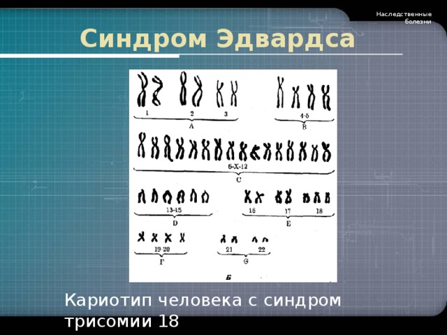 Наследственные болезни Синдром Эдвардса Кариотип человека с синдром трисомии 18