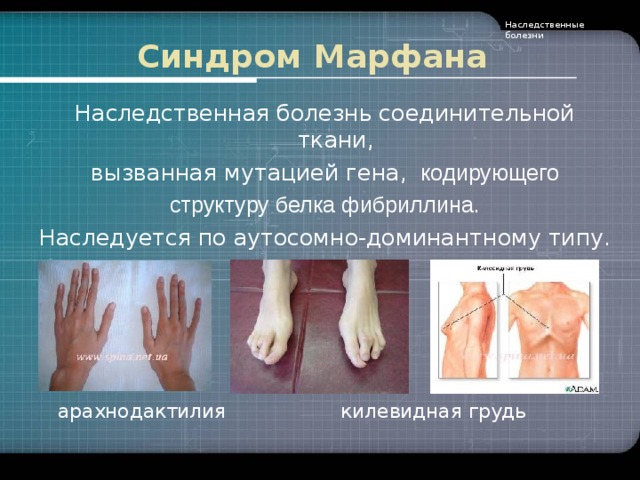 Наследственные болезни Синдром  Марфана Наследственная болезнь соединительной ткани, вызванная мутацией гена, кодирующего структуру белка фибриллина . Наследуется по аутосомно-доминантному типу.    арахнодактилия  килевидная грудь