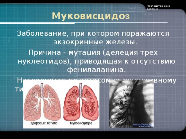 Наследственные болезни Муковисцидо з Заболевание, при котором поражаются экзокринные железы.  Причина - мутация (делеция трех нуклеотидов), приводящая к отсутствию фенилаланина.  Наследуется по аутосомно-рецессивному типу .