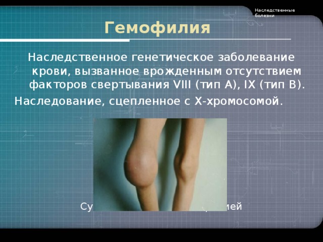 Наследственные болезни Гемофилия Наследственное генетическое заболевание крови, вызванное врожденным отсутствием факторов свертывания VIII (тип А), IX  (тип В). Наследование, сцепленное с Х-хромосомой.        Суставы больного гемофилией
