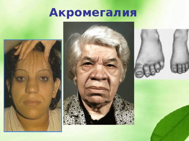 Роберт Вэдлоу с бабушкой Рост Роберта Вэдлоу составлял 2м74см. Это заболевание и привело к быстрой кончине, т.к. кровь плохо циркулировала по его телу и в последние годы жизни он вынужден был пользоваться костылями. Молодой человек отличался весьма спокойным и дружелюбным характером. 