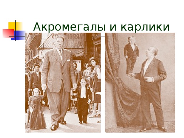 Акромегалия 