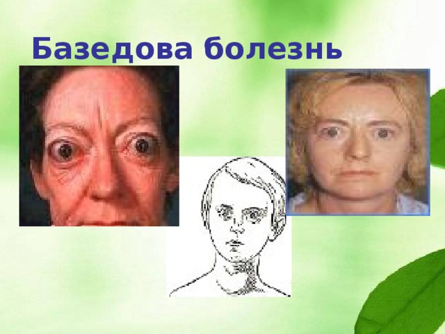 Профилактика заболеваний щитовидной железы: Йодированная поваренная соль Морская капуста (водоросль ламинария) Морская рыба Грецкие орехи Хурма 