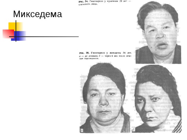 Зоб 