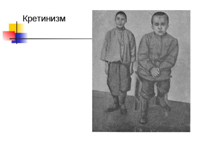 Микседема 