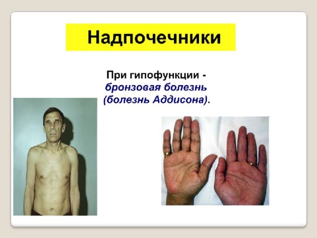 Наружный слой (корковый) Внутренний слой (мозговой)  кортикостероиды :  адреналин (минералокортикоиды, глюкокортикоиды)  норадреналин   половые гормоны  