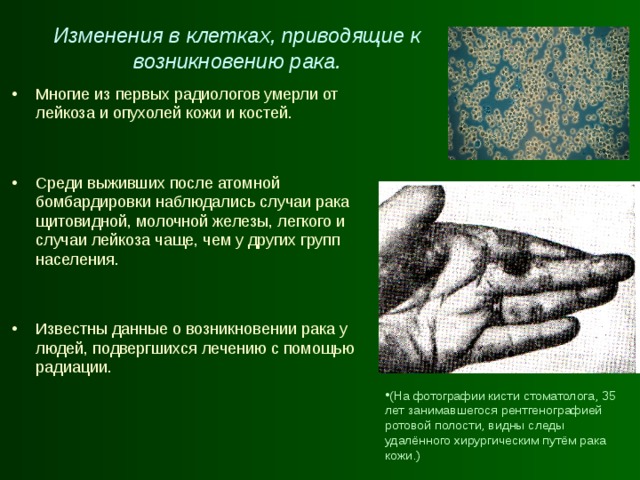 Изменения в клетках, приводящие к возникновению рака. Многие из первых радиологов умерли от лейкоза и опухолей кожи и костей.  Среди выживших после атомной бомбардировки наблюдались случаи рака щитовидной, молочной железы, легкого и случаи лейкоза чаще, чем у других групп населения.  Известны данные о возникновении рака у людей, подвергшихся лечению с помощью радиации. (На фотографии кисти стоматолога, 35 лет занимавшегося рентгенографией ротовой полости, видны следы удалённого хирургическим путём рака кожи.) 