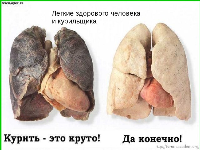 Легкие здорового человека  и курильщика 