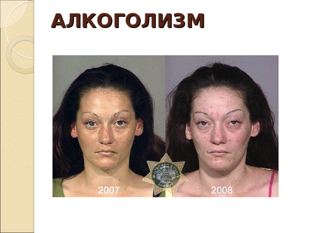 АЛКОГОЛИЗМ 