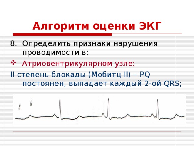 Алгоритм оценки ЭКГ Определить признаки нарушения проводимости в: Атриовентрикулярном узле: II степень блокады (Мобитц II) – PQ постоянен, выпадает каждый 2-ой QRS; 