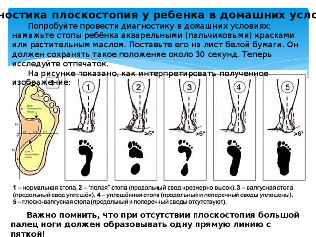 Диагностика плоскостопия у ребенка в домашних условиях Попробуйте провести диагностику в домашних условиях: намажьте стопы ребёнка акварельными (пальчиковыми) красками или растительным маслом. Поставьте его на лист белой бумаги. Он должен сохранять такое положение около 30 секунд. Теперь исследуйте отпечаток. На рисунке показано, как интерпретировать полученное изображение: Важно помнить, что при отсутствии плоскостопия большой палец ноги должен образовывать одну прямую линию с пяткой! 