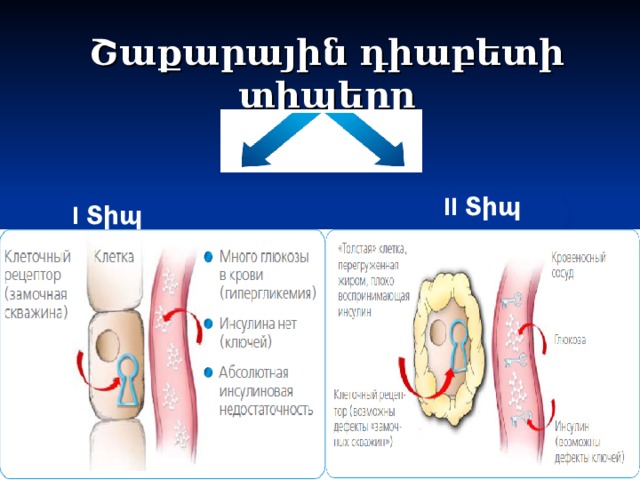 Շաքարային դիաբետի տիպերը II Տիպ I Տիպ Notes pages at the bottom  