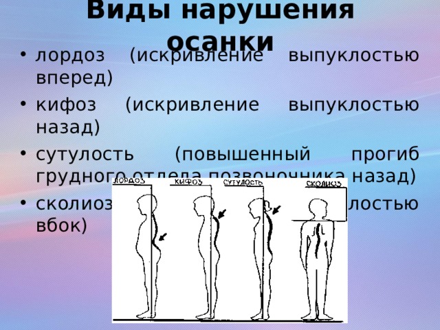 Виды нарушения осанки лордоз (искривление выпуклостью вперед) кифоз (искривление выпуклостью назад) сутулость (повышенный прогиб грудного отдела позвоночника назад) сколиоз (искривление выпуклостью вбок) 