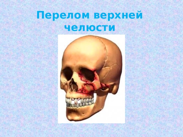 Перелом верхней челюсти 