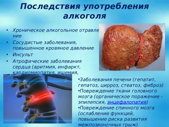 Последствия употребления алкоголя Хроническое алкогольное отравление Сосудистые заболевания, повышенное кровяное давление Инсульт Атрофические заболевания сердца (аритмия, инфаркт, кардиомиопатия, ишемия, миокардит) Заболевания печени (гепатит, гепатоз, цирроз, стеатоз, фиброз) Повреждение ткани головного мозга (органическое поражение - эпилепсия,  энцефалопатия ) Повреждение спинного мозга (ослабление функций, повышение риска развития межпозвоночных грыж) 