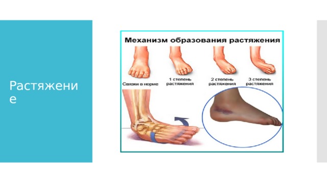 Растяжение 