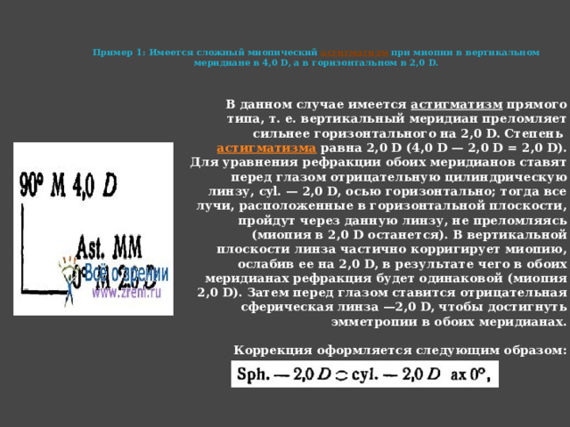     Пример 1: Имеется сложный миопический  астигматизм  при миопии в вертикальном меридиане в 4,0 D, а в горизонтальном в 2,0 D.    В данном случае имеется  астигматизм  прямого типа, т. е. вертикальный меридиан преломляет сильнее горизонтального на 2,0 D. Степень  астигматизма  равна 2,0 D (4,0 D — 2,0 D = 2,0 D). Для уравнения рефракции обоих меридианов ставят перед глазом отрицательную цилиндрическую линзу, cyl. — 2,0 D, осью горизонтально; тогда все лучи, расположенные в горизонтальной плоскости, пройдут через данную линзу, не преломляясь (миопия в 2,0 D останется). В вертикальной плоскости линза частично корригирует миопию, ослабив ее на 2,0 D, в результате чего в обоих меридианах рефракция будет одинаковой (миопия 2,0 D). Затем перед глазом ставится отрицательная сферическая линза —2,0 D, чтобы достигнуть эмметропии в обоих меридианах.   Коррекция оформляется следующим образом: 