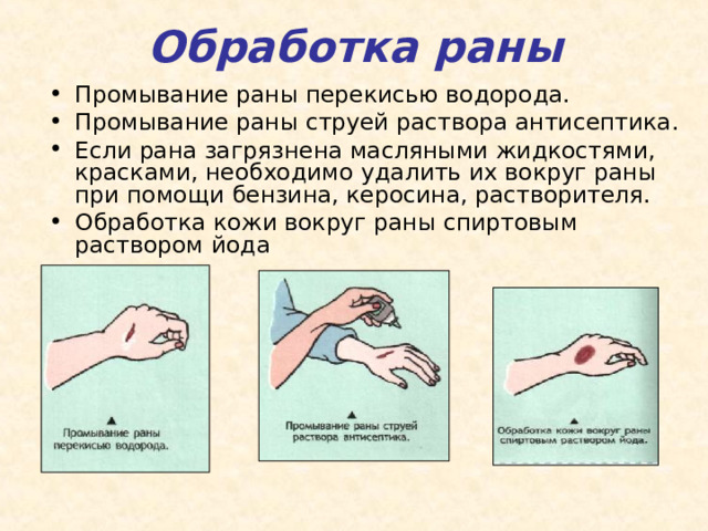 Обработка раны Промывание раны перекисью водорода. Промывание раны струей раствора антисептика. Если рана загрязнена масляными жидкостями, красками, необходимо удалить их вокруг раны при помощи бензина, керосина, растворителя. Обработка кожи вокруг раны спиртовым раствором йода 