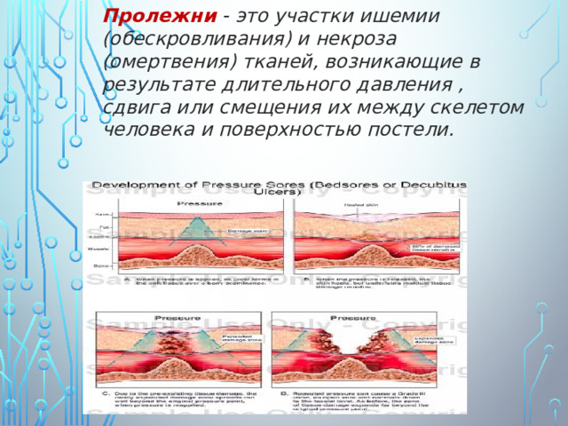 Пролежни - это участки ишемии (обескровливания) и некроза (омертвения) тканей, возникающие в результате длительного давления , сдвига или смещения их между скелетом человека и поверхностью постели. 