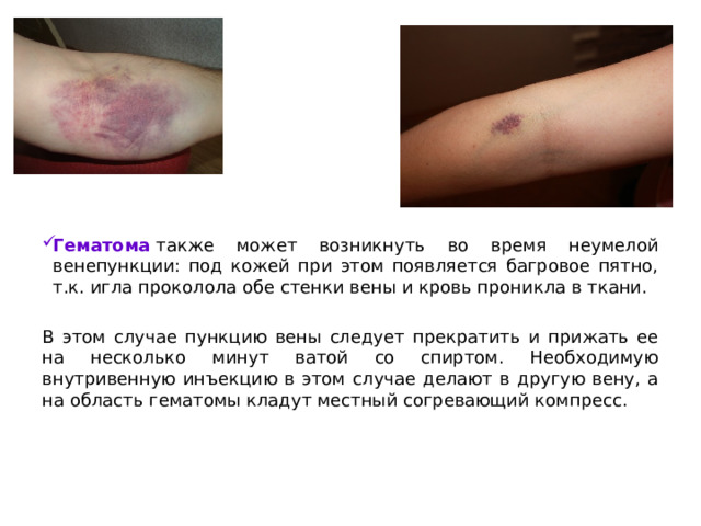 Гематома   также может возникнуть во время неумелой венепункции: под кожей при этом появляется багровое пятно, т.к. игла проколола обе стенки вены и кровь проникла в ткани. В этом случае пункцию вены следует прекратить и прижать ее на несколько минут ватой со спиртом. Необходимую внутривенную инъекцию в этом случае делают в другую вену, а на область гематомы кладут местный согревающий компресс.      