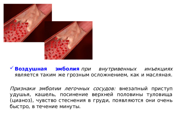 Воздушная эмболия   при внутривенных инъекциях является таким же грозным осложнением, как и масляная.  Признаки эмболии легочных сосудов: внезапный приступ удушья, кашель, посинение верхней половины туловища (цианоз), чувство стеснения в груди, появляются они очень быстро, в течение минуты.  