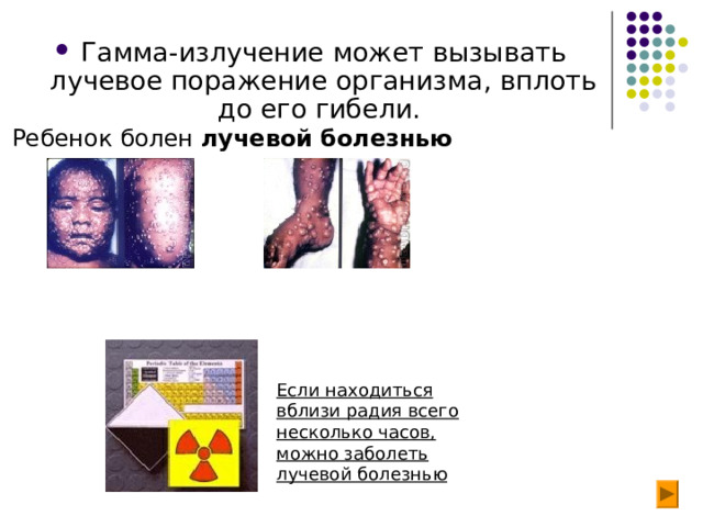 Гамма-излучение может вызывать лучевое поражение организма, вплоть до его гибели. Ребенок болен лучевой  болезнью Если находиться вблизи радия всего несколько часов, можно заболеть лучевой болезнью