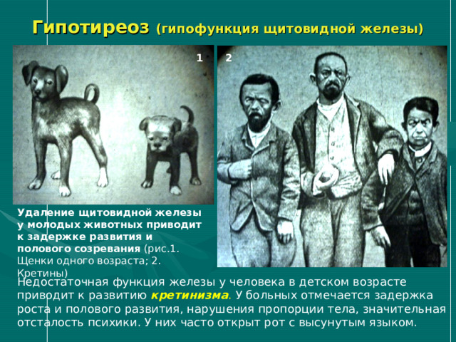 Гипотиреоз (гипофункция щитовидной железы) 1 2 Удаление щитовидной железы у молодых животных приводит к задержке развития и полового созревания (рис.1. Щенки одного возраста; 2. Кретины) Недостаточная функция железы у человека в детском возрасте приводит к развитию кретинизма . У больных отмечается задержка роста и полового развития, нарушения пропорции тела, значительная отсталость психики. У них часто открыт рот с высунутым языком. 