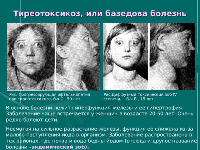Тиреотоксикоз, или базедова болезнь Рис. Прогрессирующая офтальмопатия при тиреотоксикозе, б-я С., 50 лет. Рис.Диффузный токсический зоб IV степени, б-я Б., 15 лет. В основе болезни лежит гиперфункция железы и ее гипертрофия. Заболевание чаще встречается у женщин в возрасте 20-50 лет. Очень редко болеют дети. Несмотря на сильное разрастание железы, функция ее снижена из-за малого поступления йода в организм. Заболевание распространено в тех районах, где почва и вода бедны йодом (отсюда и другое название болезни – эндемический зоб). 