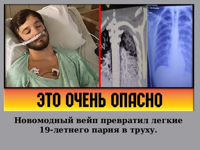 Новомодный вейп превратил легкие 19-летнего парня в труху. 
