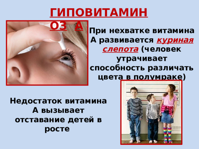 ГИПОВИТАМИНОЗ  А При нехватке витамина А развивается куриная слепота (человек утрачивает способность различать цвета в полумраке) Недостаток витамина А вызывает отставание детей в росте 