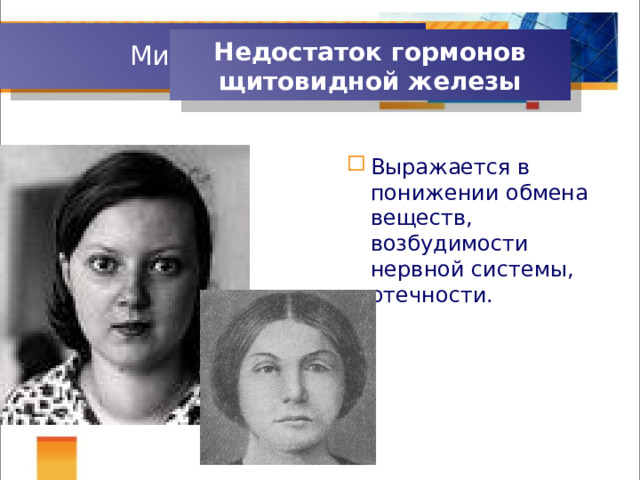 Микседема Недостаток гормонов щитовидной железы Выражается в понижении обмена веществ, возбудимости нервной системы, отечности. 