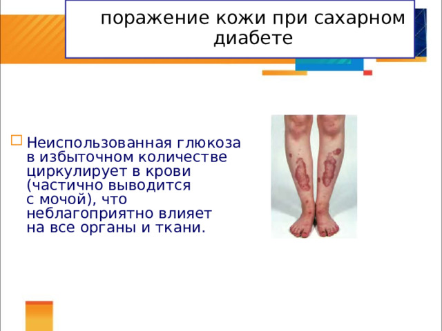  поражение кожи при сахарном диабете   Неиспользованная глюкоза в избыточном количестве циркулирует в крови (частично выводится с мочой), что неблагоприятно влияет на все органы и ткани. 