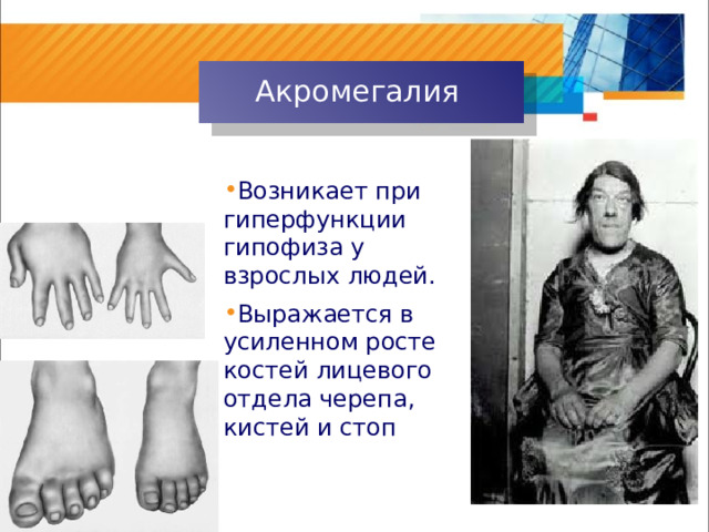 Акромегалия Возникает при гиперфункции гипофиза у взрослых людей. Выражается в усиленном росте костей лицевого отдела черепа, кистей и стоп 